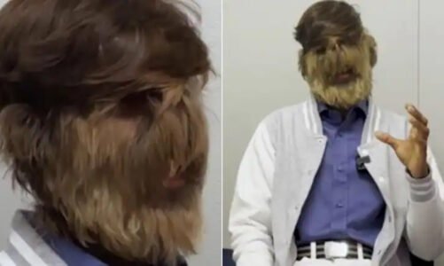 सबसे अधिक बालों वाले चेहरे के साथ मध्य प्रदेश के लड़के ने बनाया गिनीज वर्ल्ड रिकॉर्ड, जानें कैसे फेस पर आए इतने हेयर?